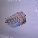 신사역치과 라미네이트 잘하는곳 누런 치아 고민 해결 대만족