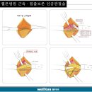 [고관절통증] 장마철, 특히 주의해야 하는 '고관절' 이미지