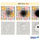 실명 전조 (망막혈관폐쇄, 안구통증, 망막박리 날파리증 광시증) 이미지