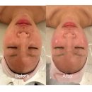 의정부 경락 [루비나] 안면 비대칭개선 솔직후기