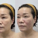 대구 알테온 윤곽관리 널위한뷰티, 북구탄력관리로 엄마 얼굴 리프팅 대만족 후기