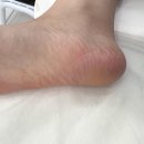 레푸스청라점 | [ 인천 청라 패디플래닝 ] 문제성 발관리, 레푸스 인천청라점