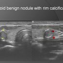 Thyroid benign nodule with rim calcification 이미지