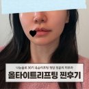 양실장피부관리실 | 청담피부과 옥순리프팅 올타이트 400샷 내돈내산 솔직 후기(효과, 통증 등)