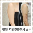 부천한병원 | 부천다이어트병원 팔뚝 지방추출주사 한달차 후기 #4