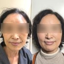 타임락뷰티 - 수성구 | 피부과 튠페이스 내돈내산 60대 리프팅 타임락튠 1차 일주일 후기 (비포에프터 사진O)