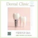 어울림치과의원 | <서초 어울림치과> 임플란트 꼭 해야 할까요?(4)