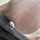 리오풋케어 | 동대문발각질 환절기 뒤꿈치 관리는 여기! 리오풋케어