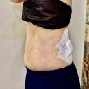 러브멍멍 | 러브핸들빼는법 지방추출주사 2주차 효과 솔직 후기