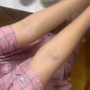 서연약국 | [서연아이여성의원 5일차] 대망의 난자 채취일 &amp; 정자 채취