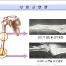 상완골 골절 이미지