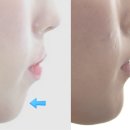 에버스마일치과교정과치과의원 | 광진구 교정치과, 거미스마일(잇몸웃음)과 돌출입 비발치 교정으로 개선한 케이스