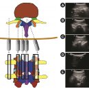 Re:Ultrasonography for lumbar neuraxial block 초음파 진단 이미지