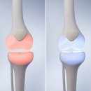 뼈주사, 연골주사, DNA주사, 프롤로주사 , 자가골수 줄기세포 주사, 차이점 이미지