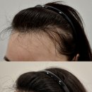 헤어라인 이미지