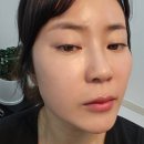 강남 언주역 피부과 텐써마+쥬베룩 콜라겐리프팅 피부장벽까지 챙긴 꿀조합 후기