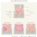 크론병 초기증상 이미지