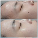 제석초등학교 | 광주피부관리/올가드림뷰티 봉선점 모공디톡스 후기