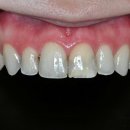 스마일라인치과의원 | [ 마곡치과_웨딩 스마일 준비3 ] 결혼식 전 치아모양 개선, 인상이 달라진다