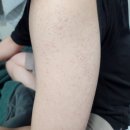 선약국 | 팔뚝 모공각화증 약국 아이템, 클리어틴·유리아크림 사용 후기