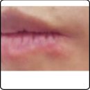 라이프모티브 | 라이프모티브 레이저 조사기 추천받은 후기(입술수포로 고생)