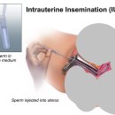 인공수정과 시험관시술(IVF) 그리고 정자직접주입술(ICSI) 이미지