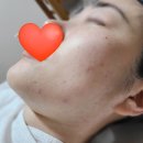[용인/수지] 성복역 트러블피부전문 더에이치뷰티 - 여드름 압출 관리 받고 물광피부 된 후기