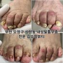 내성발톱발톱무좀관리김수정뷰티 이미지