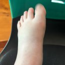 코리아정형외과의원 | [골절] 나의 발 골절 일지 1. (리스프랑 인대 손상, 쐐기뼈·입방뼈 골절, 비수술적 치료)