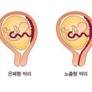 태반 조기 박리[Abruptio placenta]여성질환 이미지