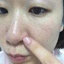 비발란스 | 비발란스 앰플 사용후기 첫날