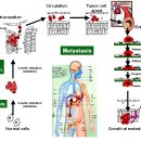 Re:임파선 전이는 어떻게 나타나는가요? 이미지
