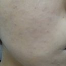 타비 | 세비타비겔 여드름에 효과 본 내돈내산 후기