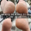 문제성 손발톱 전문관리 케어톱톱