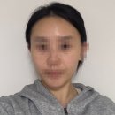 씨엘의원 | 물광주사 효과, 한 겨울 속 건조 잡는 방법 (실제 후기)