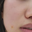 케이트의원 | 홍대 울트라콜 케이트의원에서 팔자주름 맞은 후기