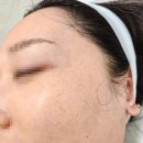 수정시흥-D-1 | 광명 철산역 기미 잡티 제거 미작뷰티 시흥점 제로스팟 후기