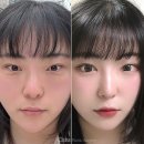 트임수술, 시원하게 확! 위 + 뒤밑트임(180도 달라짐♡)