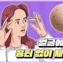 지방종 원인 2가지 제거수술 발생 부위(등 목뒤 허벅지 얼굴 팔) 이미지