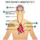 심방세동과 뇌졸중(腦卒中)-심장내과 최기준 교수 이미지