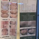 영통 안아픈 압출, 영통 여드름 전문센터 &#39;리솔르에스테틱&#39; 후기