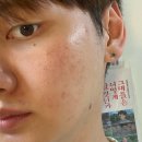 엑스텀 | 여드름 흉터 서브시전 시술 ‘엑스카’ 후기 (남자 여드름 흉터, 없애는법, 제거, 레이저 가격, 관리)