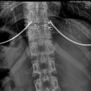 Annular fissure at L4-5 &amp; Central Protruded herniated disc at L5-S1 이미지