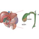 급성 담낭염(Acute cholecystitis)소화기 질환이란? 이미지