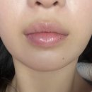 쥬네르의원 | 광주 쥬네르의원 이마필러 &amp; 입술필러 후기 (8개월차 내돈내산)