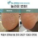 닥터페디(동래온천점) | 동래 발각질 케어는 실력있는 닥터페디 동래온천점에서 알아보세요