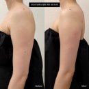 7459 | [화성/동탄] 동탄신부관리 팔뚝 소멸핏:온유어에스테틱 후기