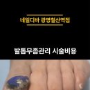 70대 여성 고객님 고민만하시다 무좀발톱관리받으러 오셨어요ㅣ네일디바 광명철산역점 이미지