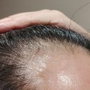 엘엔피 | 결국 답은 꾸준함이었습니다 | M자 변화 기록