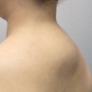 고려의원 | 유스의원 버팔로험프 버섯목 유스키니 치료 후기